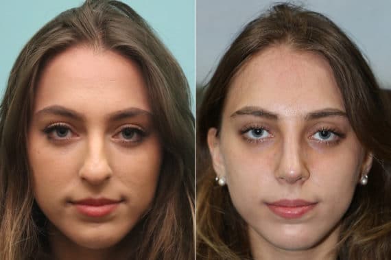 Before and after Rhinoplasty by Dr. Shervin Naderi, Patient 22470