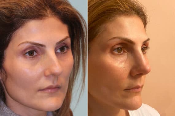 Before and after Rhinoplasty by Dr. Shervin Naderi, Patient 22592