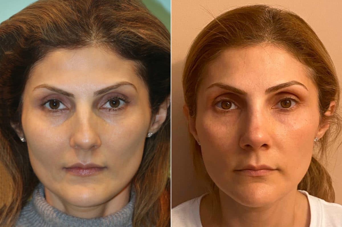 Before and after Rhinoplasty by Dr. Shervin Naderi, Patient 22592