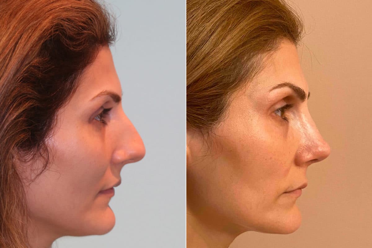 Before and after Rhinoplasty by Dr. Shervin Naderi, Patient 22592