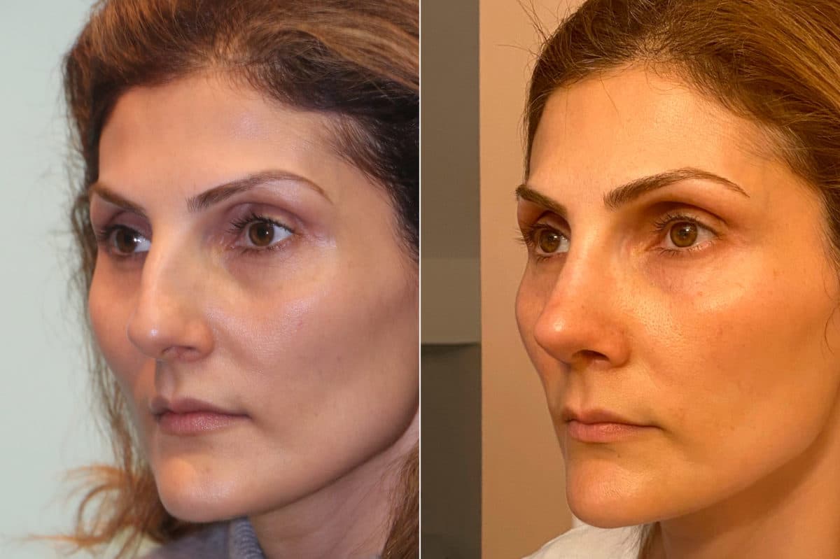 Before and after Rhinoplasty by Dr. Shervin Naderi, Patient 22592