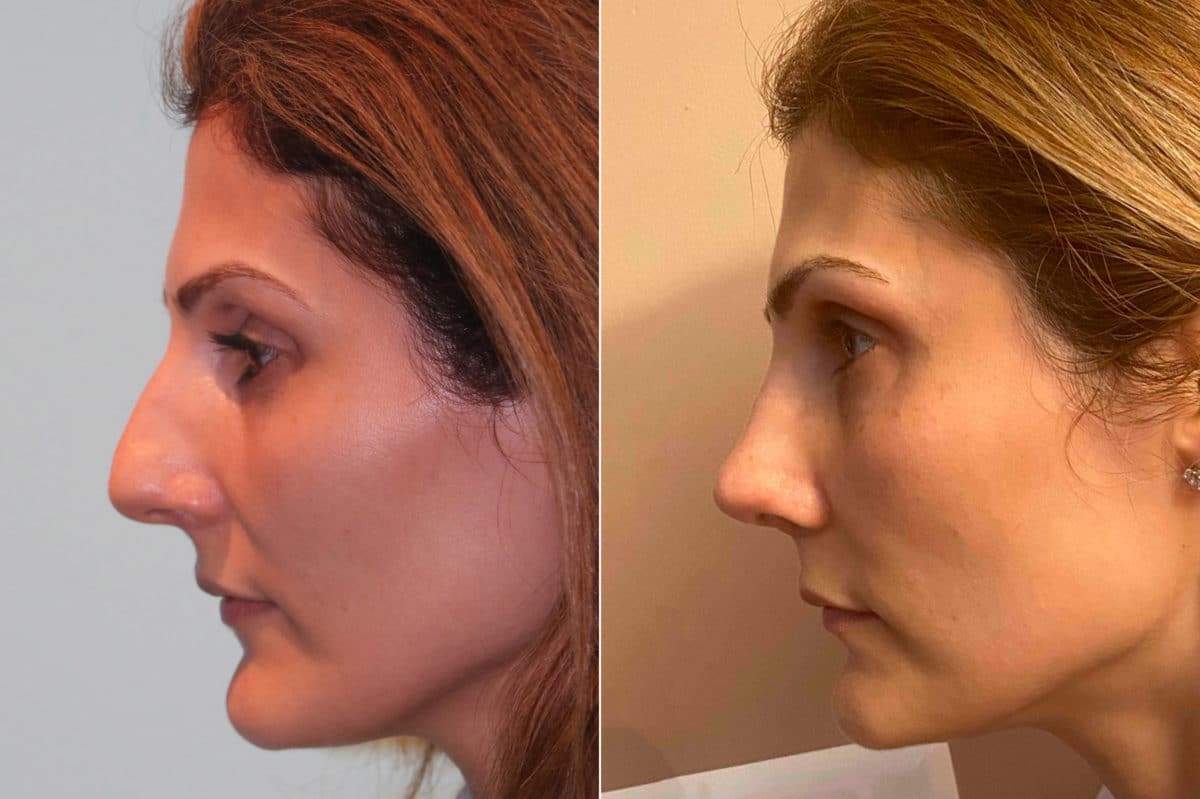 Before and after Rhinoplasty by Dr. Shervin Naderi, Patient 22592