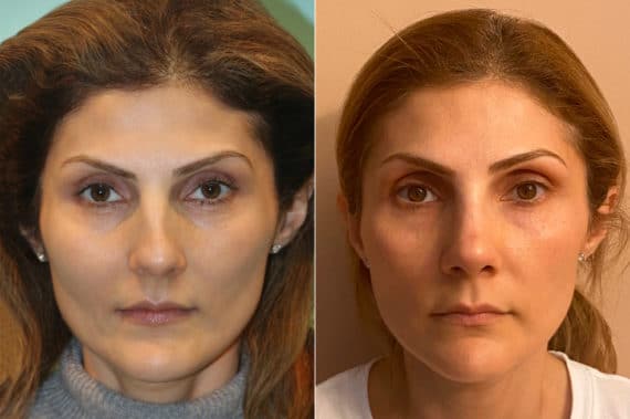 Before and after Rhinoplasty by Dr. Shervin Naderi, Patient 22592