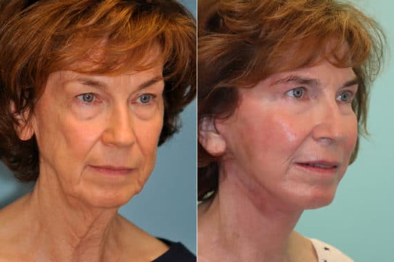 Before and after Skin Resurfacing by Dr. Shervin Naderi, Patient 22609