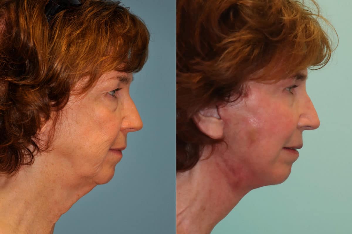 Before and after Skin Resurfacing by Dr. Shervin Naderi, Patient 22609