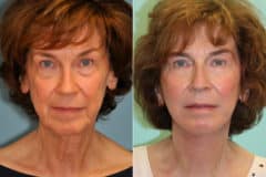 Before and after Skin Resurfacing by Dr. Shervin Naderi, Patient 22609