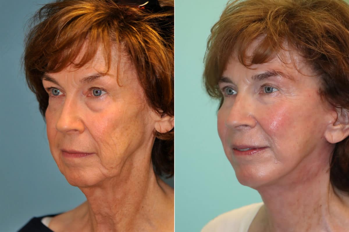 Before and after Skin Resurfacing by Dr. Shervin Naderi, Patient 22609