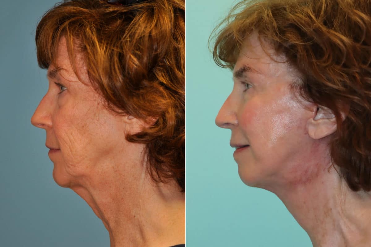 Before and after Skin Resurfacing by Dr. Shervin Naderi, Patient 22609