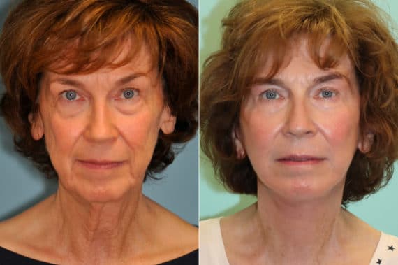 Before and after Skin Resurfacing by Dr. Shervin Naderi, Patient 22609