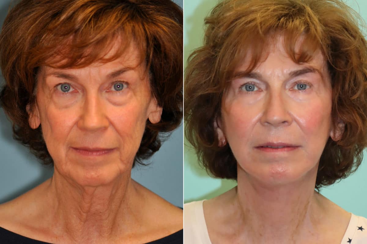 Before and after Facelift by Dr. Shervin Naderi, Patient 22610