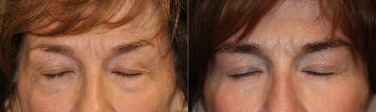 Before and after Blepharoplasty by Dr. Shervin Naderi, Patient 22611