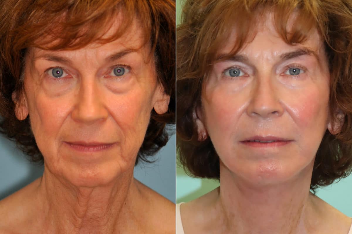 Before and after Blepharoplasty by Dr. Shervin Naderi, Patient 22611