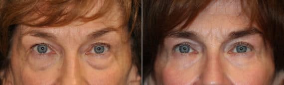 Before and after Blepharoplasty by Dr. Shervin Naderi, Patient 22611