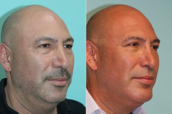 Before and after Blepharoplasty by Dr. Shervin Naderi, Patient 22654