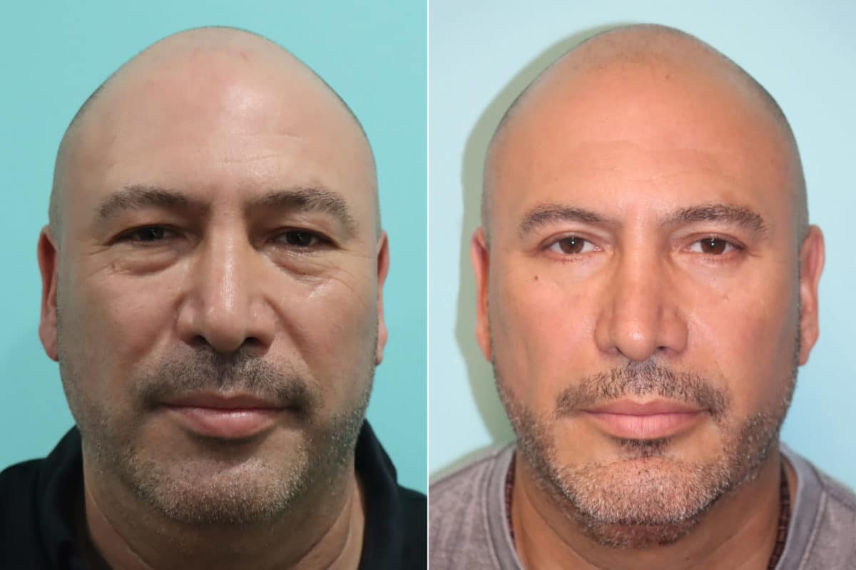 Before and after Submentoplasty by Dr. Shervin Naderi, Patient 22655