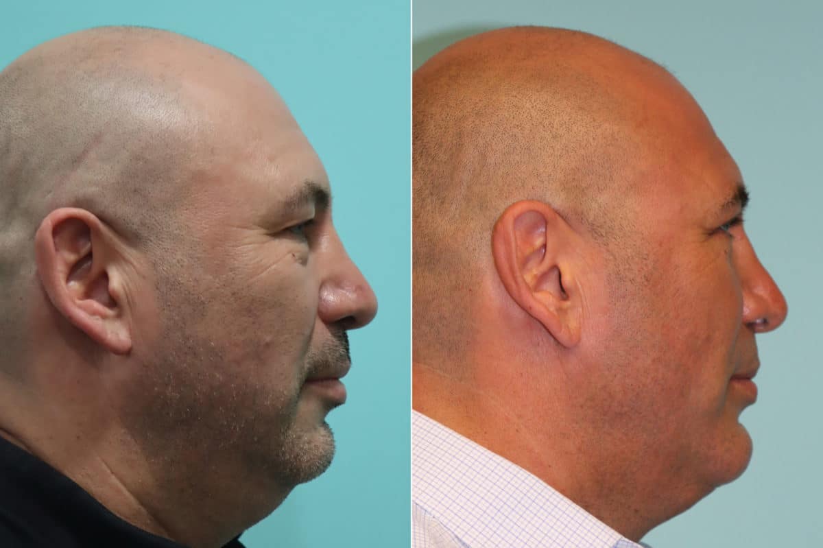 Before and after Submentoplasty by Dr. Shervin Naderi, Patient 22655