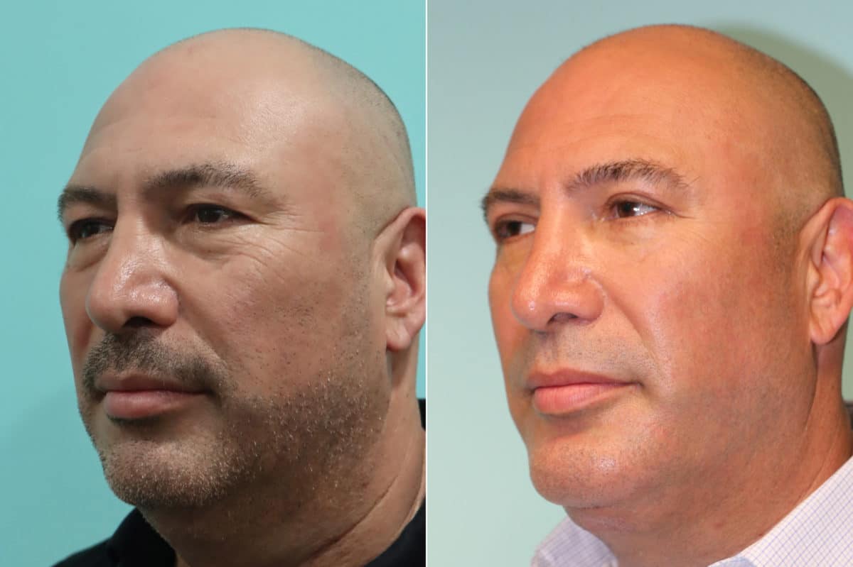 Before and after Submentoplasty by Dr. Shervin Naderi, Patient 22655