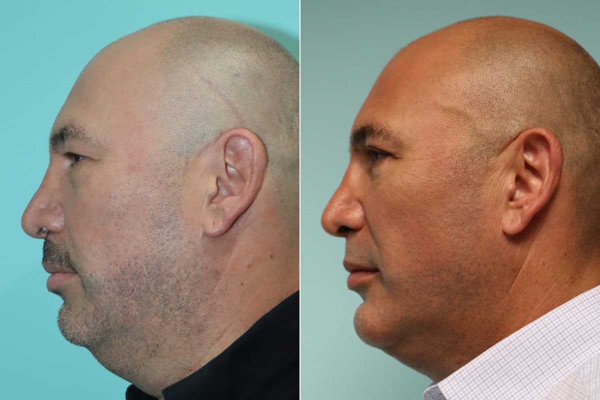 Before and after Submentoplasty by Dr. Shervin Naderi, Patient 22655