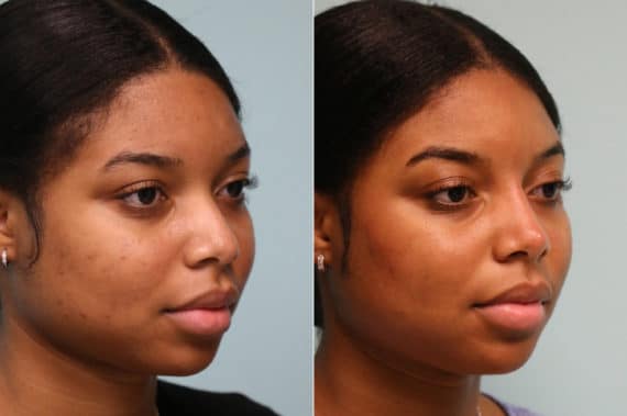 Before and after Non-Surgical Rhinoplasty by Dr. Shervin Naderi, Patient 22821