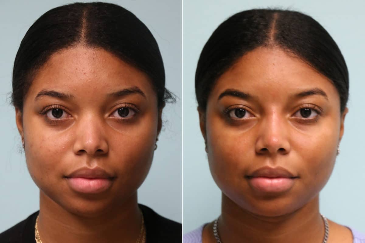 Before and after Non-Surgical Rhinoplasty by Dr. Shervin Naderi, Patient 22821