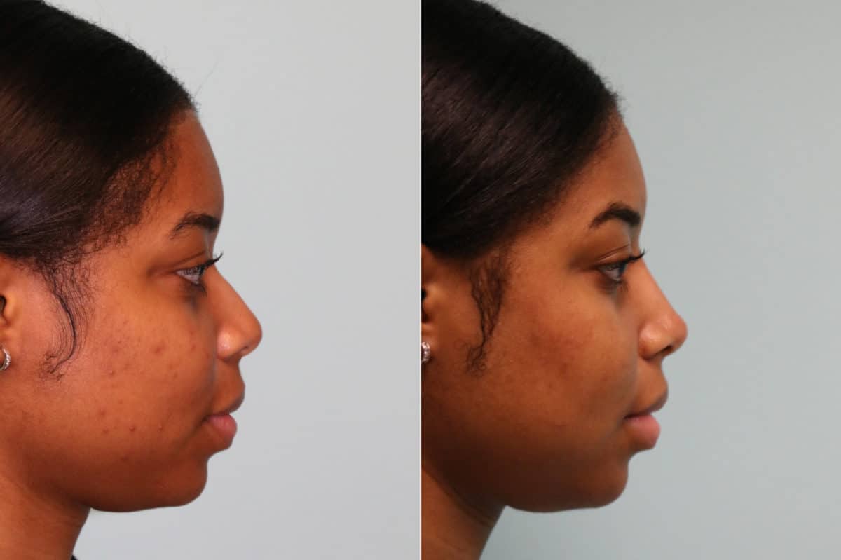 Before and after Non-Surgical Rhinoplasty by Dr. Shervin Naderi, Patient 22821