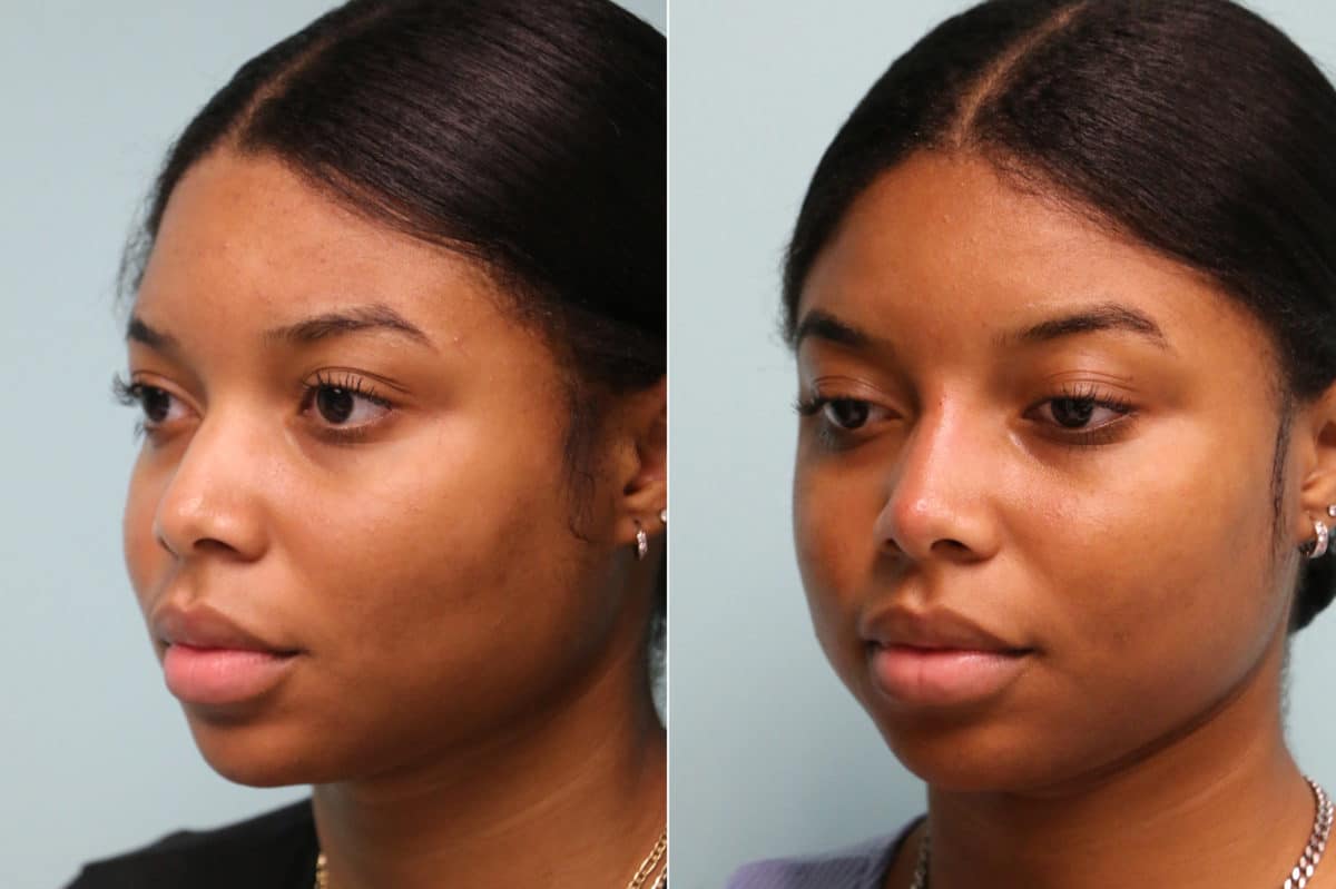 Before and after Non-Surgical Rhinoplasty by Dr. Shervin Naderi, Patient 22821