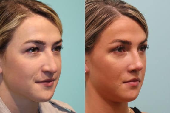 Before and after Rhinoplasty by Dr. Shervin Naderi, Patient 22837