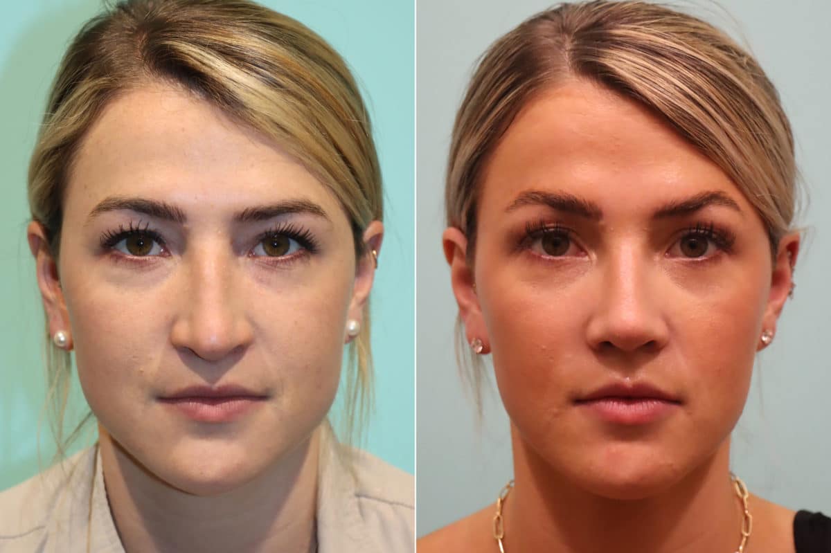 Before and after Rhinoplasty by Dr. Shervin Naderi, Patient 22837