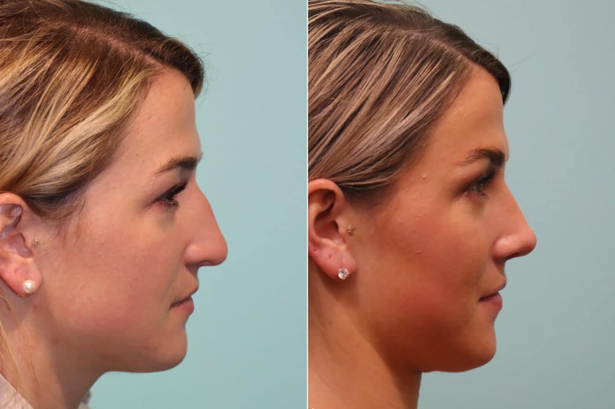 Before and after Rhinoplasty by Dr. Shervin Naderi, Patient 22837