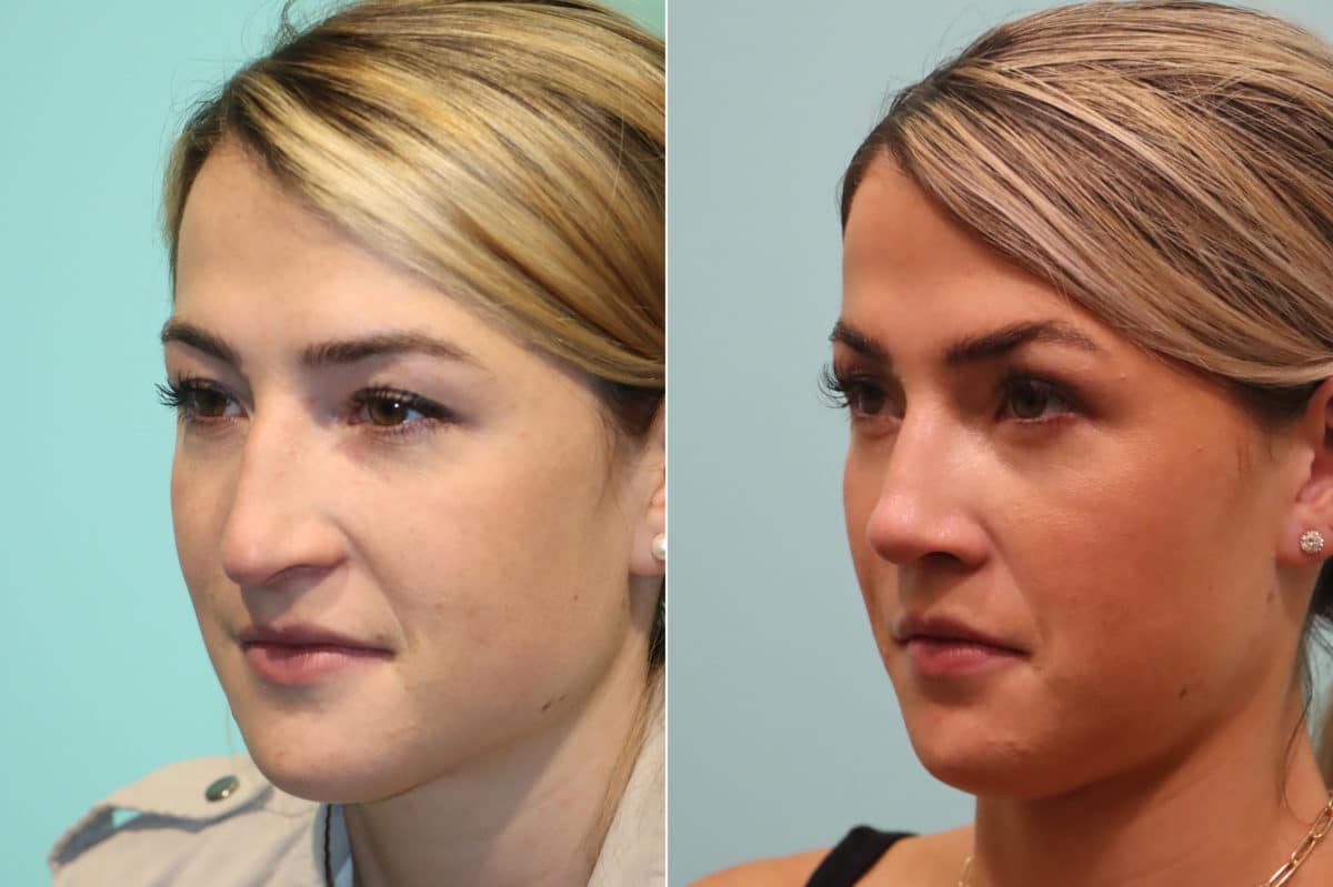 Before and after Rhinoplasty by Dr. Shervin Naderi, Patient 22837