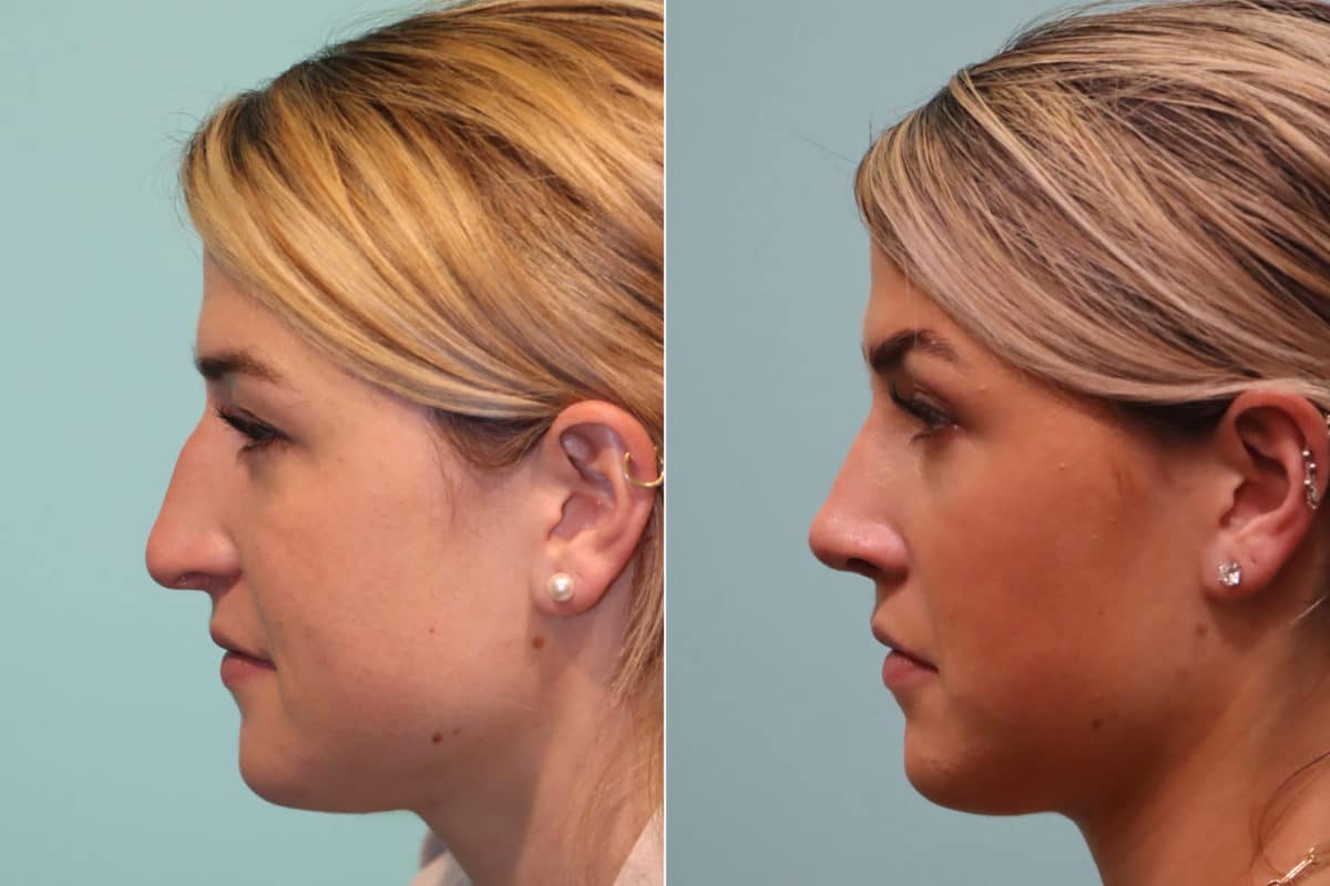 Before and after Rhinoplasty by Dr. Shervin Naderi, Patient 22837