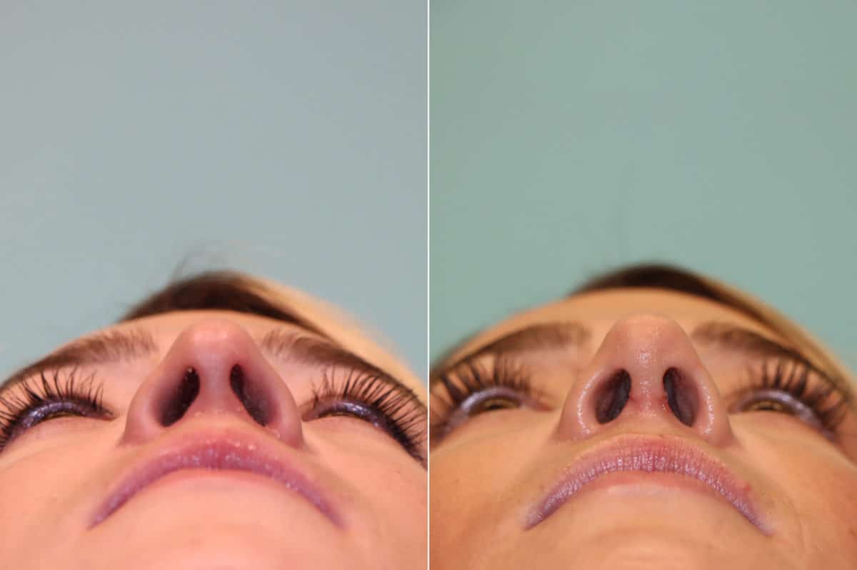 Before and after Rhinoplasty by Dr. Shervin Naderi, Patient 22837