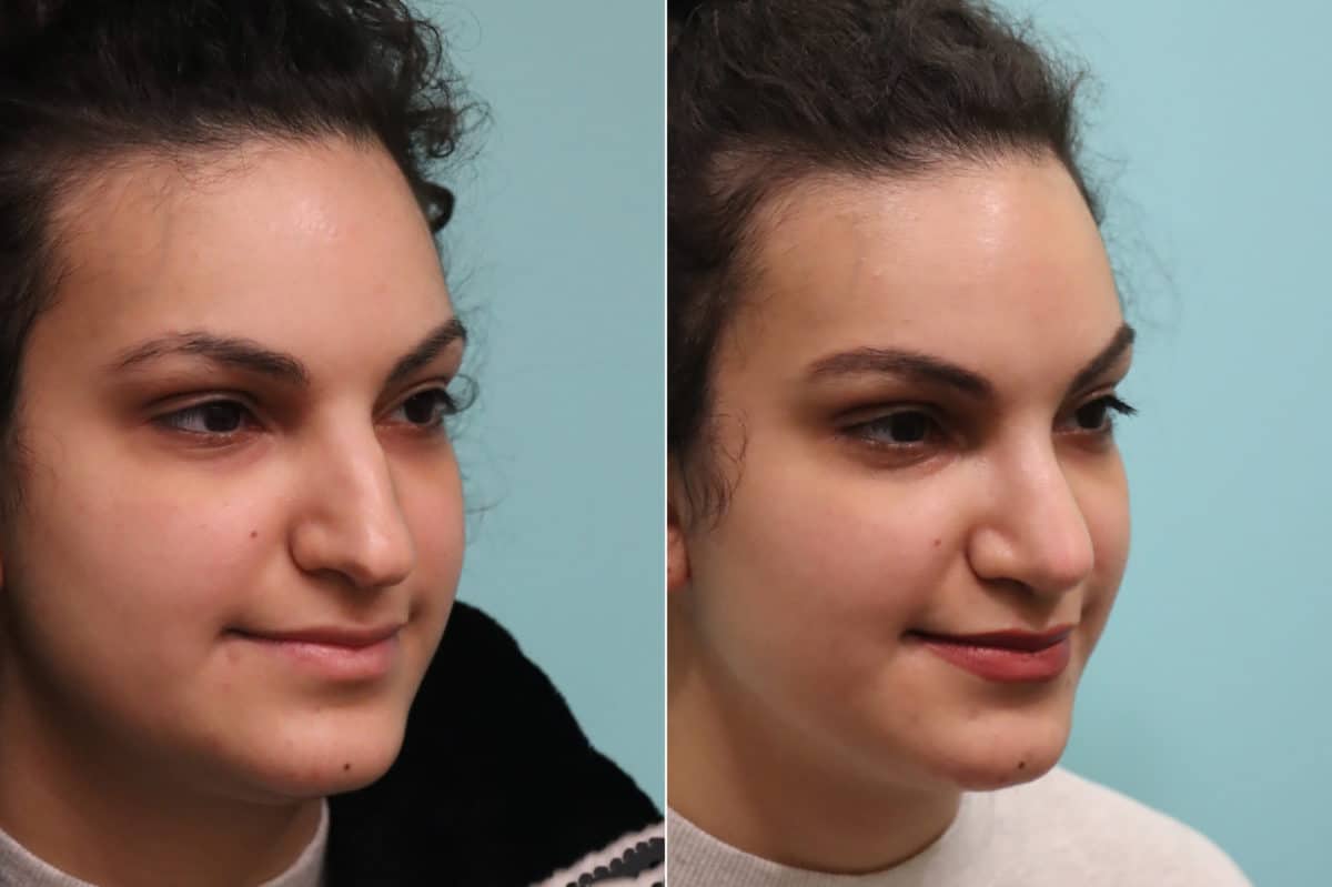 Before and after Rhinoplasty by Dr. Shervin Naderi, Patient 22857