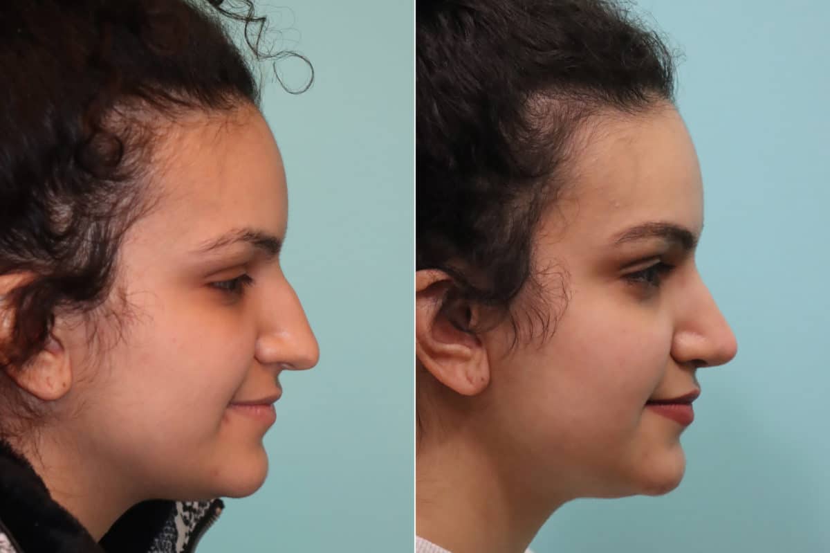 Before and after Rhinoplasty by Dr. Shervin Naderi, Patient 22857