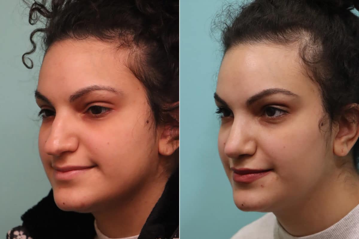 Before and after Rhinoplasty by Dr. Shervin Naderi, Patient 22857