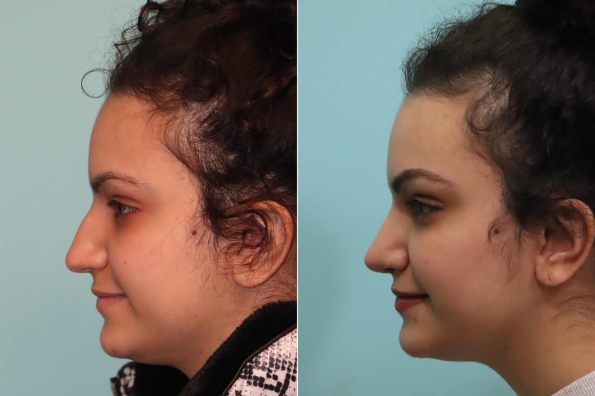 Before and after Rhinoplasty by Dr. Shervin Naderi, Patient 22857