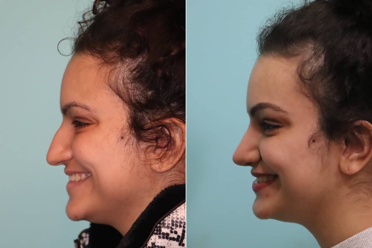 Before and after Rhinoplasty by Dr. Shervin Naderi, Patient 22857