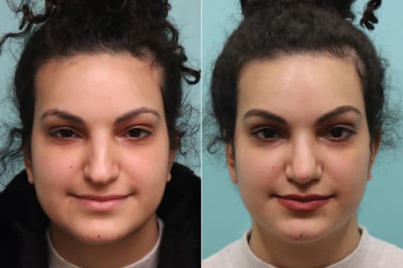 Before and after Rhinoplasty by Dr. Shervin Naderi, Patient 22857