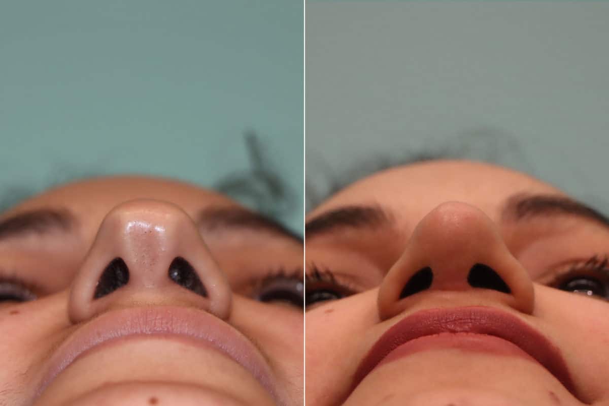 Before and after Rhinoplasty by Dr. Shervin Naderi, Patient 22857