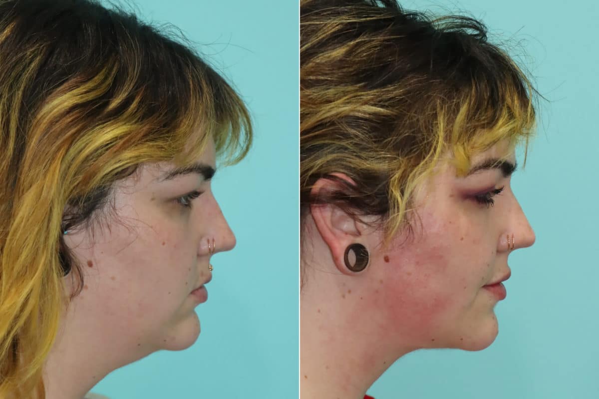 Before and after Submentoplasty by Dr. Shervin Naderi, Patient 22859