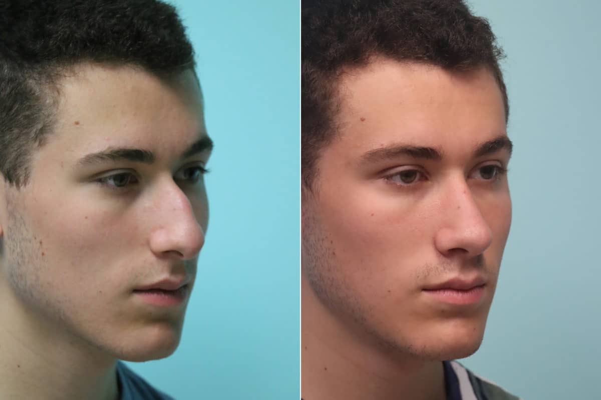 Before and after Rhinoplasty by Dr. Shervin Naderi, Patient 22908