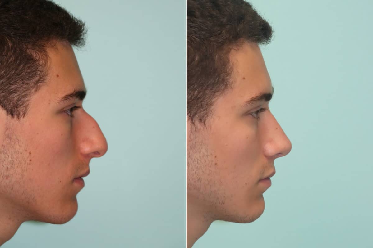 Before and after Rhinoplasty by Dr. Shervin Naderi, Patient 22908