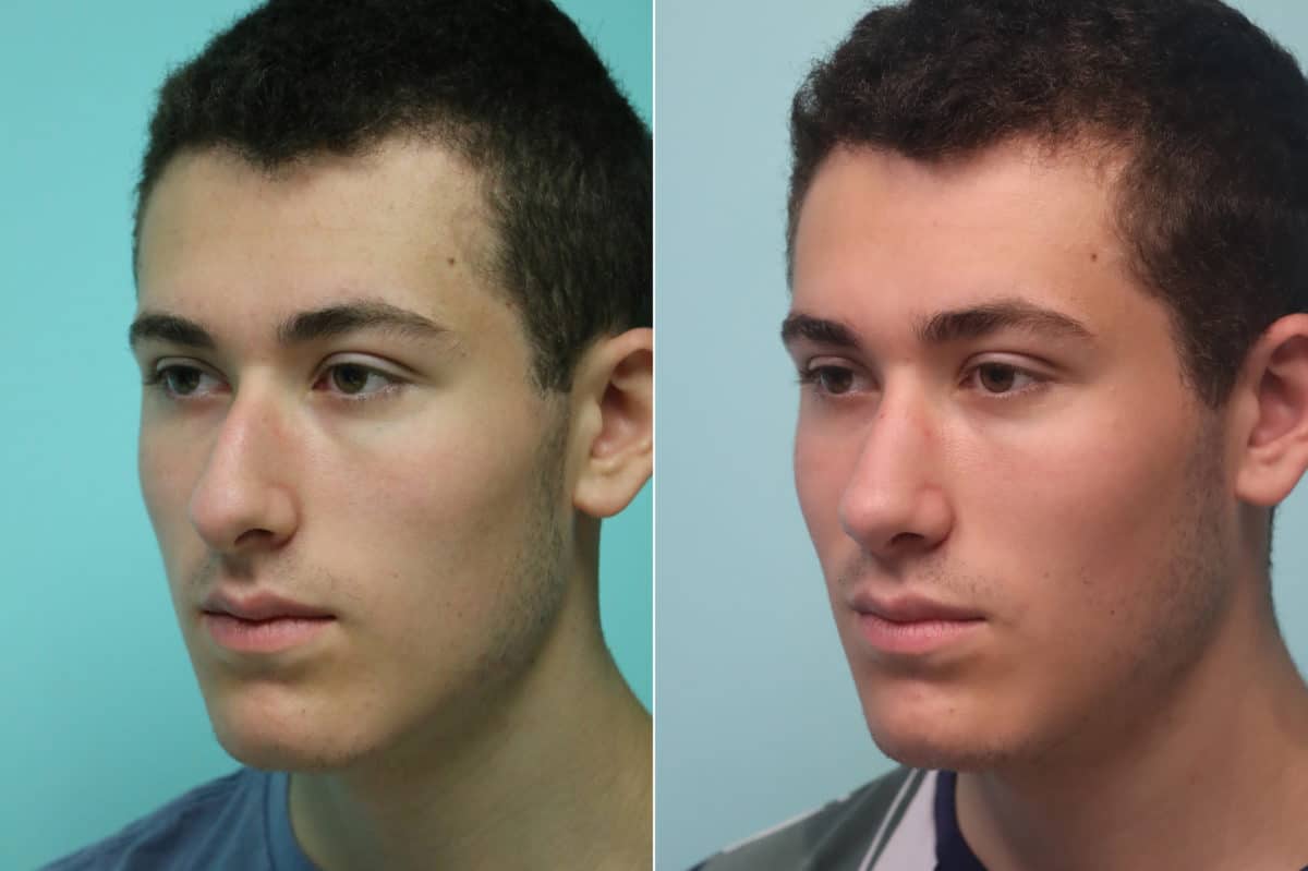 Before and after Rhinoplasty by Dr. Shervin Naderi, Patient 22908