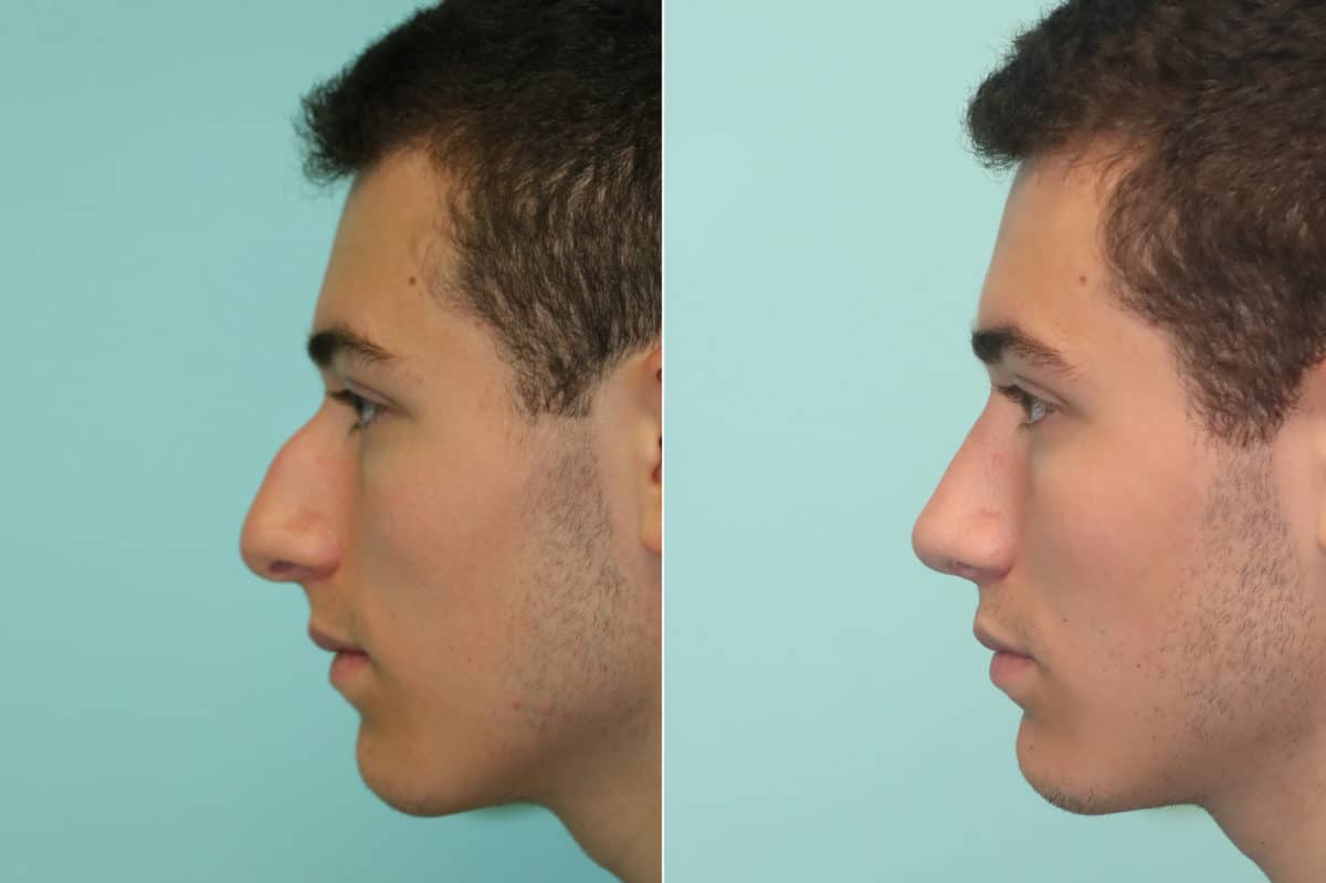 Before and after Rhinoplasty by Dr. Shervin Naderi, Patient 22908