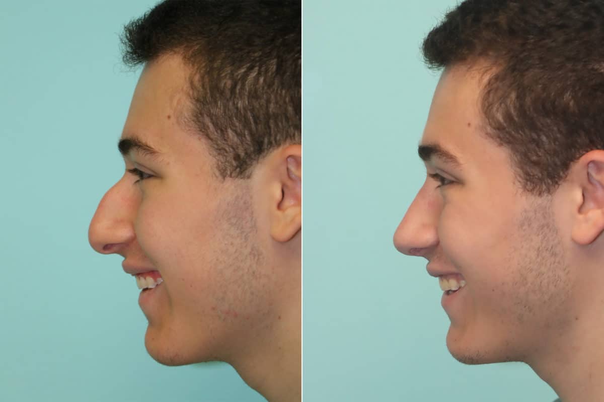 Before and after Rhinoplasty by Dr. Shervin Naderi, Patient 22908