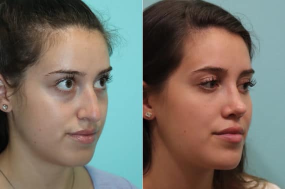 Before and after Rhinoplasty by Dr. Shervin Naderi, Patient 22936