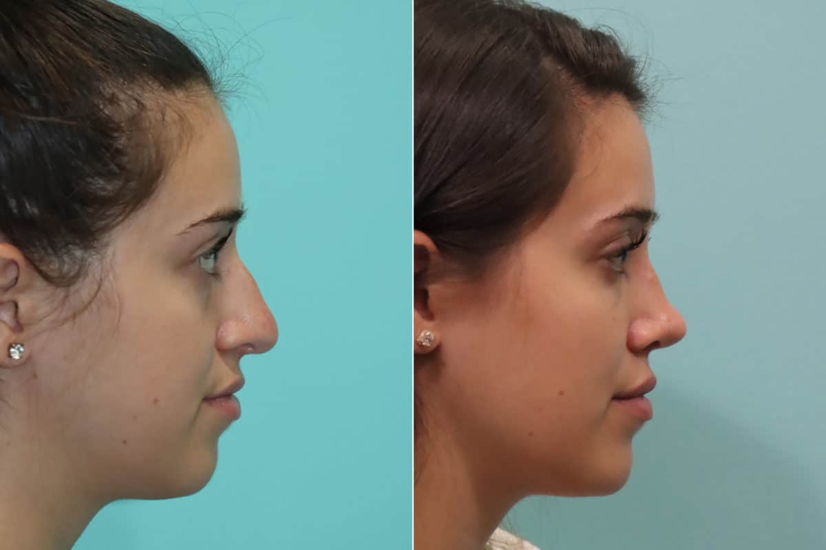 Before and after Rhinoplasty by Dr. Shervin Naderi, Patient 22936