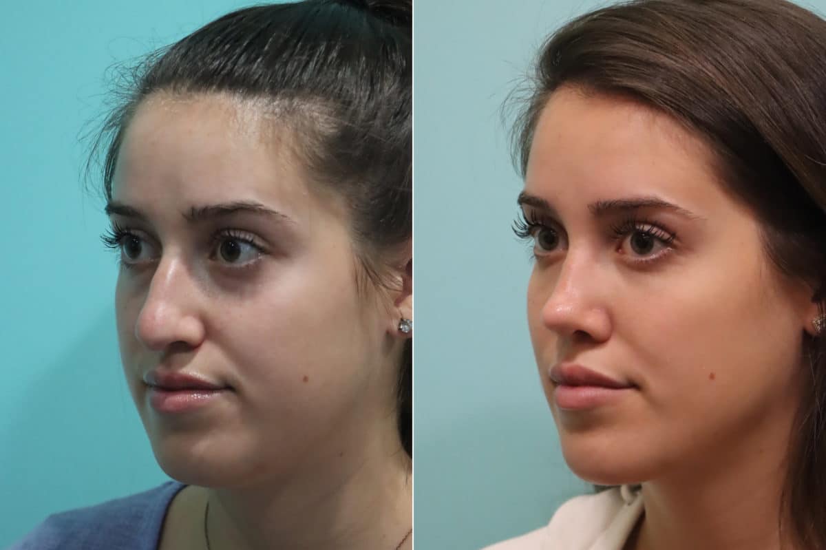 Before and after Rhinoplasty by Dr. Shervin Naderi, Patient 22936