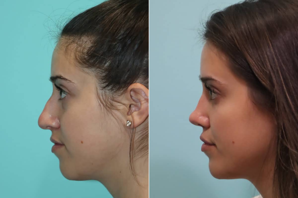 Before and after Rhinoplasty by Dr. Shervin Naderi, Patient 22936