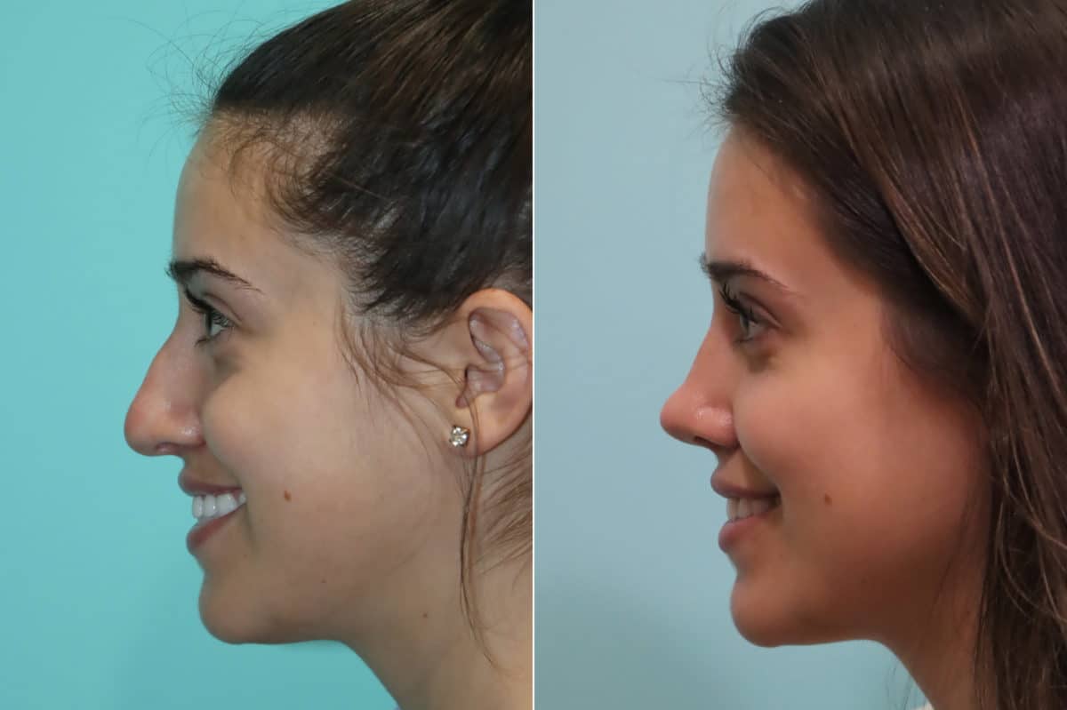 Before and after Rhinoplasty by Dr. Shervin Naderi, Patient 22936